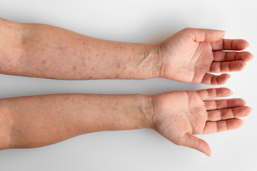 Dermatite de Contato: Causas e Tratamento